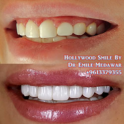 ceramic veneers lebanon