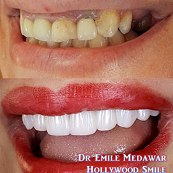 porcelain veneers lebanon beirut