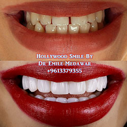 veneers lebanon