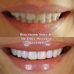 veneers lebanon