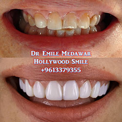 veneers beirut