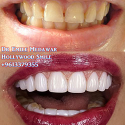 veneers in lebanon