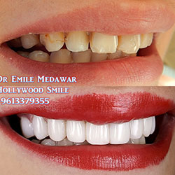 veneers lebanon beirut