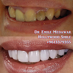 composite veneers lebanon