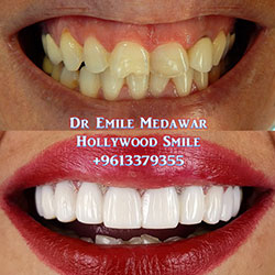 composite veneers beirut