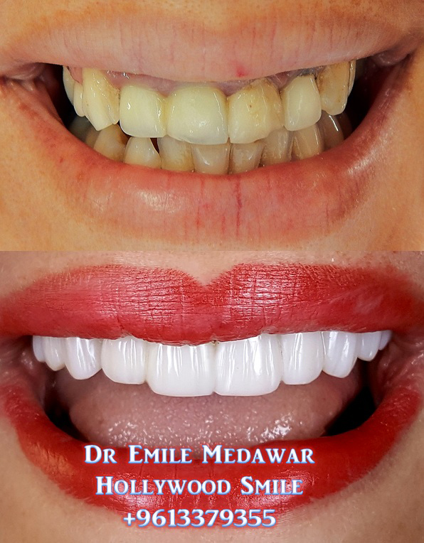 Direct Veneers