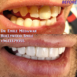 veneers price beirut