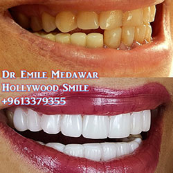 porcelain veneers lebanon