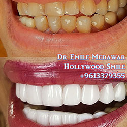 porcelain veneers beirut