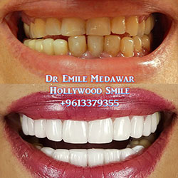 dental veneers lebanon