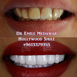 dentist veneers beirut