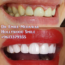 veneers beirut