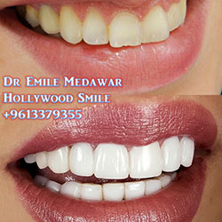 veneers lebanon beirut