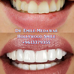veneers before after
