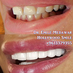 veneers cost lebanon