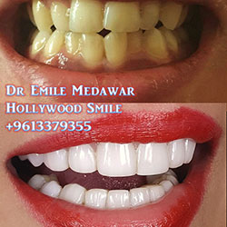 veneers lebanon cost