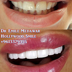 veneers beirut cost