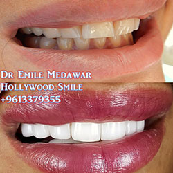 veneers cost beirut