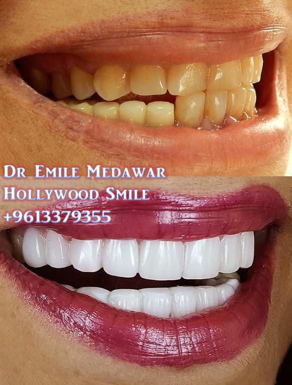 Emax Veneers