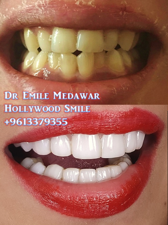 Emax Veneers