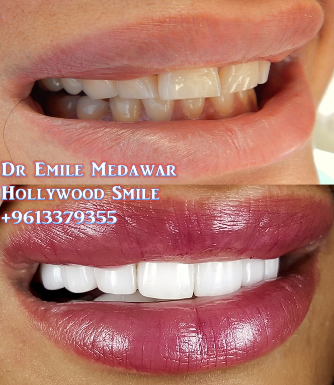 Emax Veneers