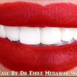 veneers lebanon beirut