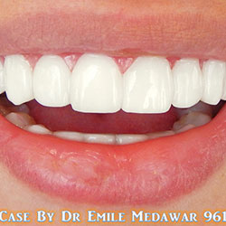 best Hollywood Smile in lebanon