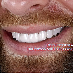 top Hollywood smile