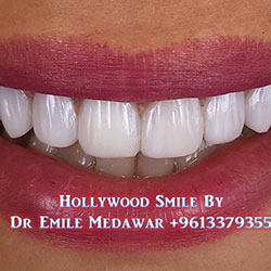 best Hollywood Smile beirut